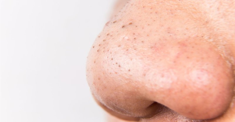 Nặn mụn đầu đen ở mũi thế nào cho đỡ hại da?